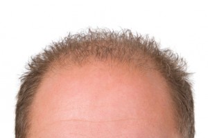 diffuser Haarausfall