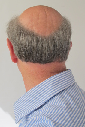 androgenetische Alopezie, erblich bedingter Haarausfall
